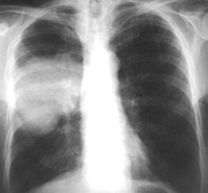 Καρκίνος δεξιού πνεύμονος
